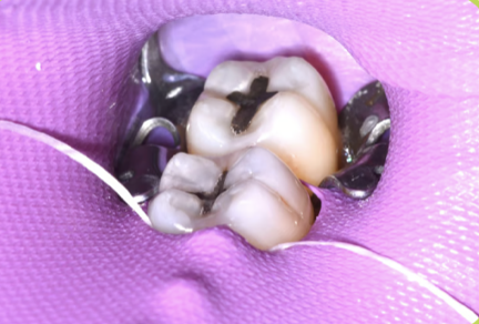 Dique de goma colocado