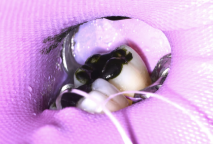 Chlorella aplicada tras retirada