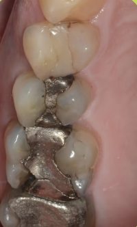 Amalgamas dentales de mercurio