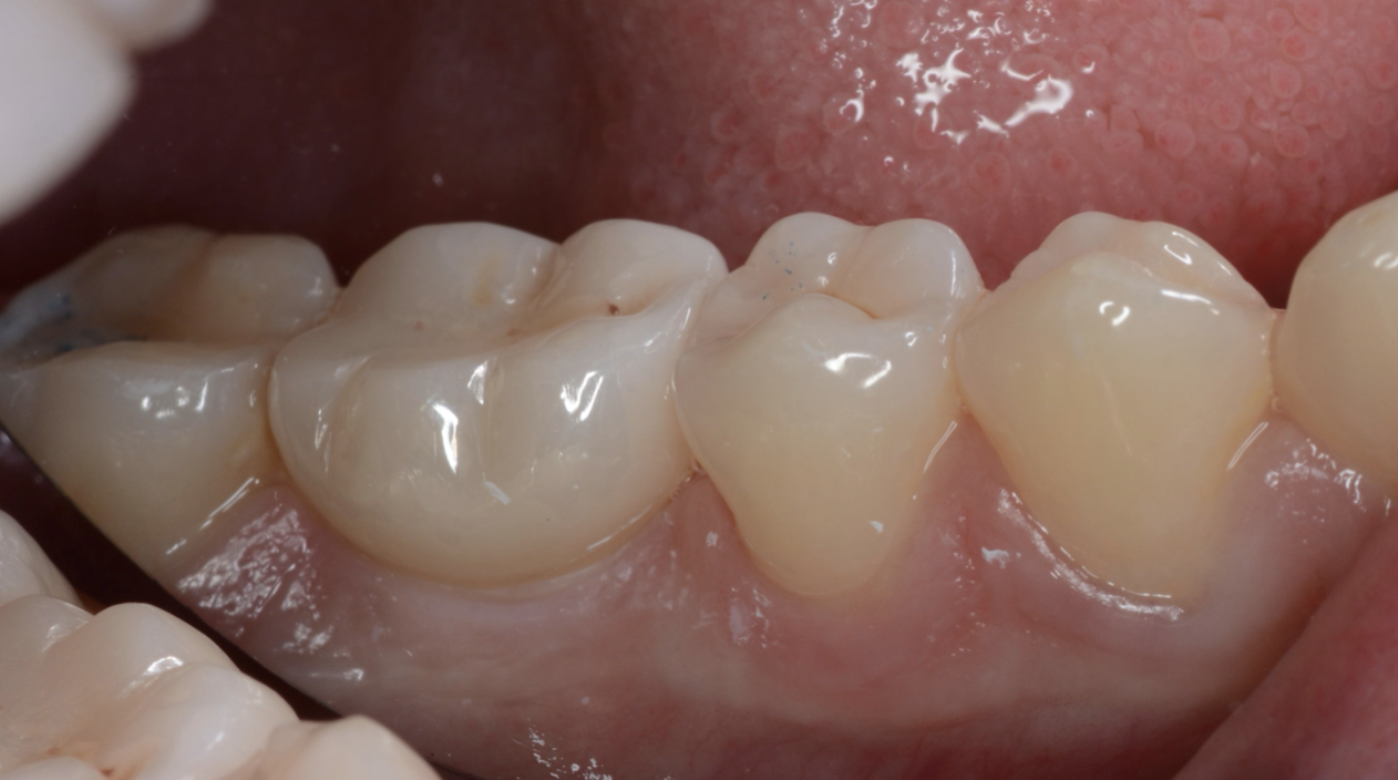 Couronne sur implant céramique