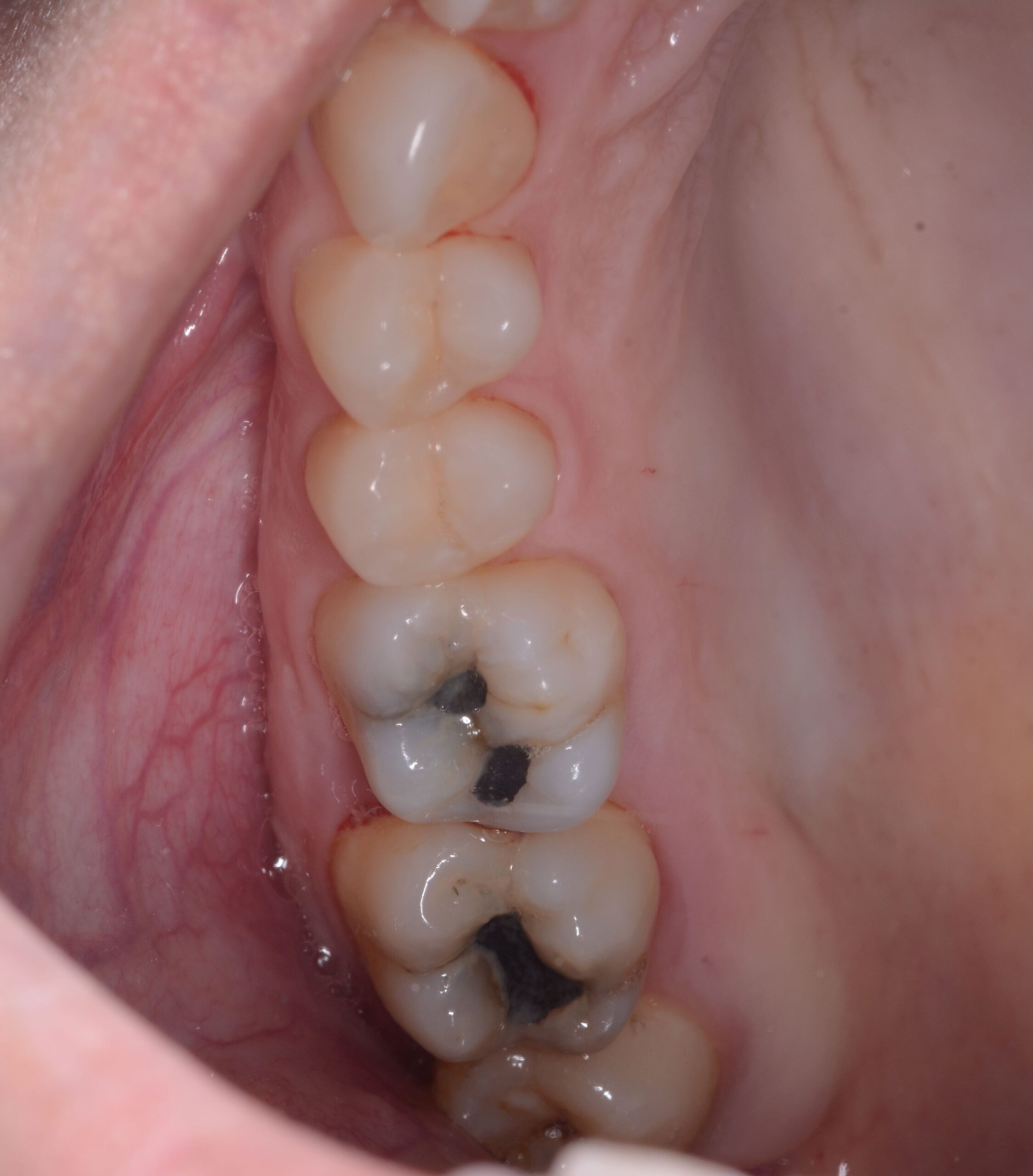 Muelas con amalgamas de mercurio
